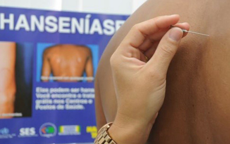 Hanseníase: o mal que ainda está presente na sociedade – Grupo Livemed